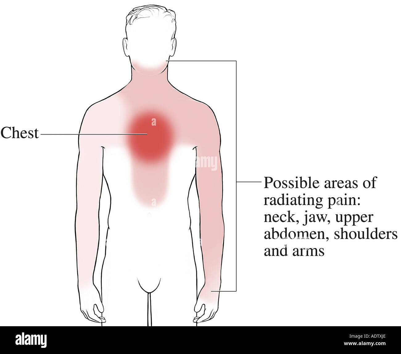 Ноющая боль в верхней части. Локализация боли в грудине. Боль при стенокардии. Локализация стенокардии. Стенокардия иррадиация болей.