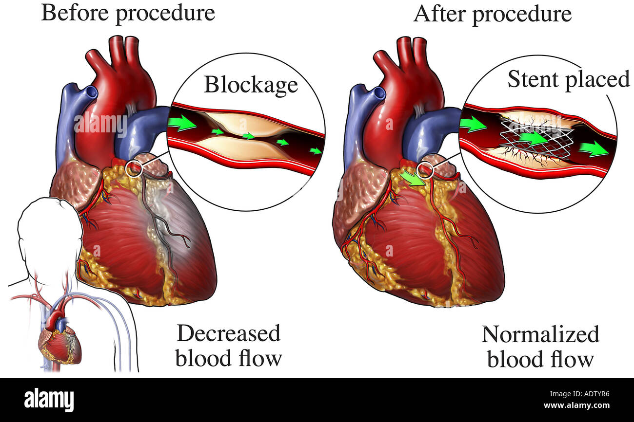 Bloqueo arterial fotografías e imágenes de alta resolución Alamy