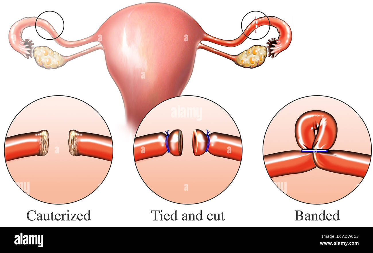 Сколько труб у женщины. Хирургическая стерилизация маточных труб. Добровольная стерилизация маточных труб. Хирургические методы контрацепции. Перевязка труб у женщин.