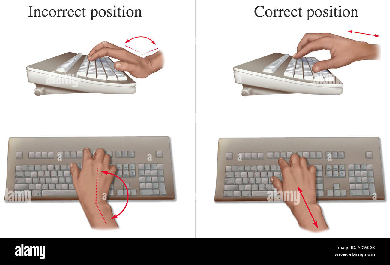 Prevención del Túnel Carpiano: Posición de las manos en el teclado ergonómico Foto de stock