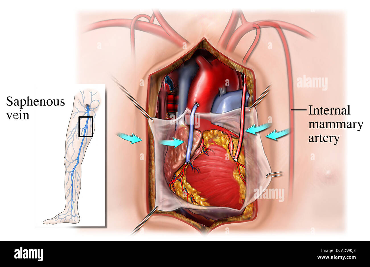 Injerto de derivación de la arteria coronaria: post-operatorio Foto de stock