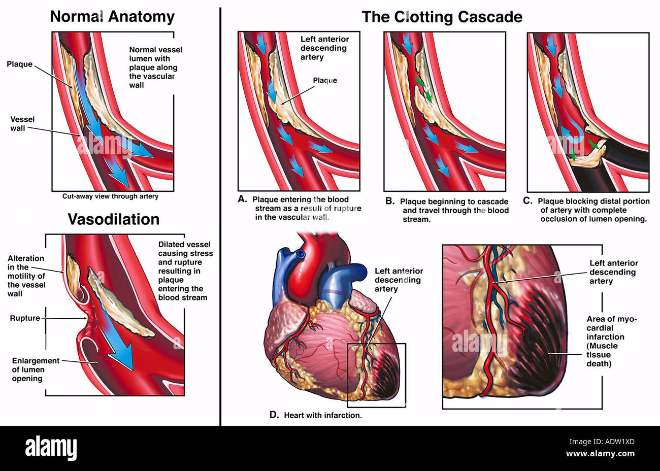 Mecanismo de infarto de miocardio debido a la ruptura de la arteria coronaria Foto de stock