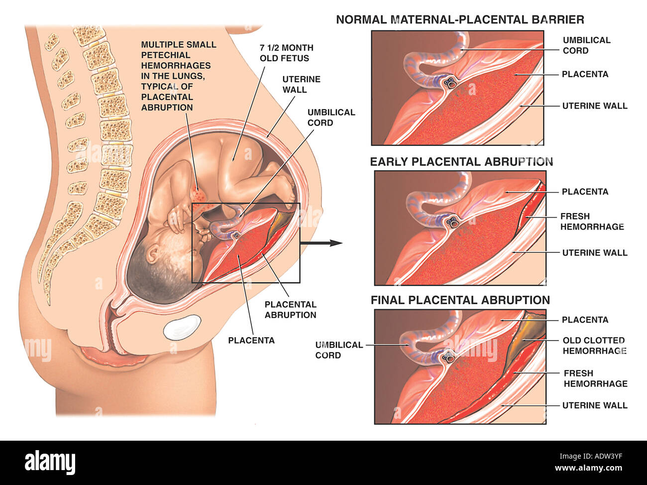 Post-traumático de desprendimiento de placenta Foto de stock