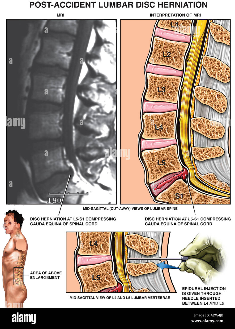 Top 19 mejores operación hernia discal l5-s1 tornillos en 2022