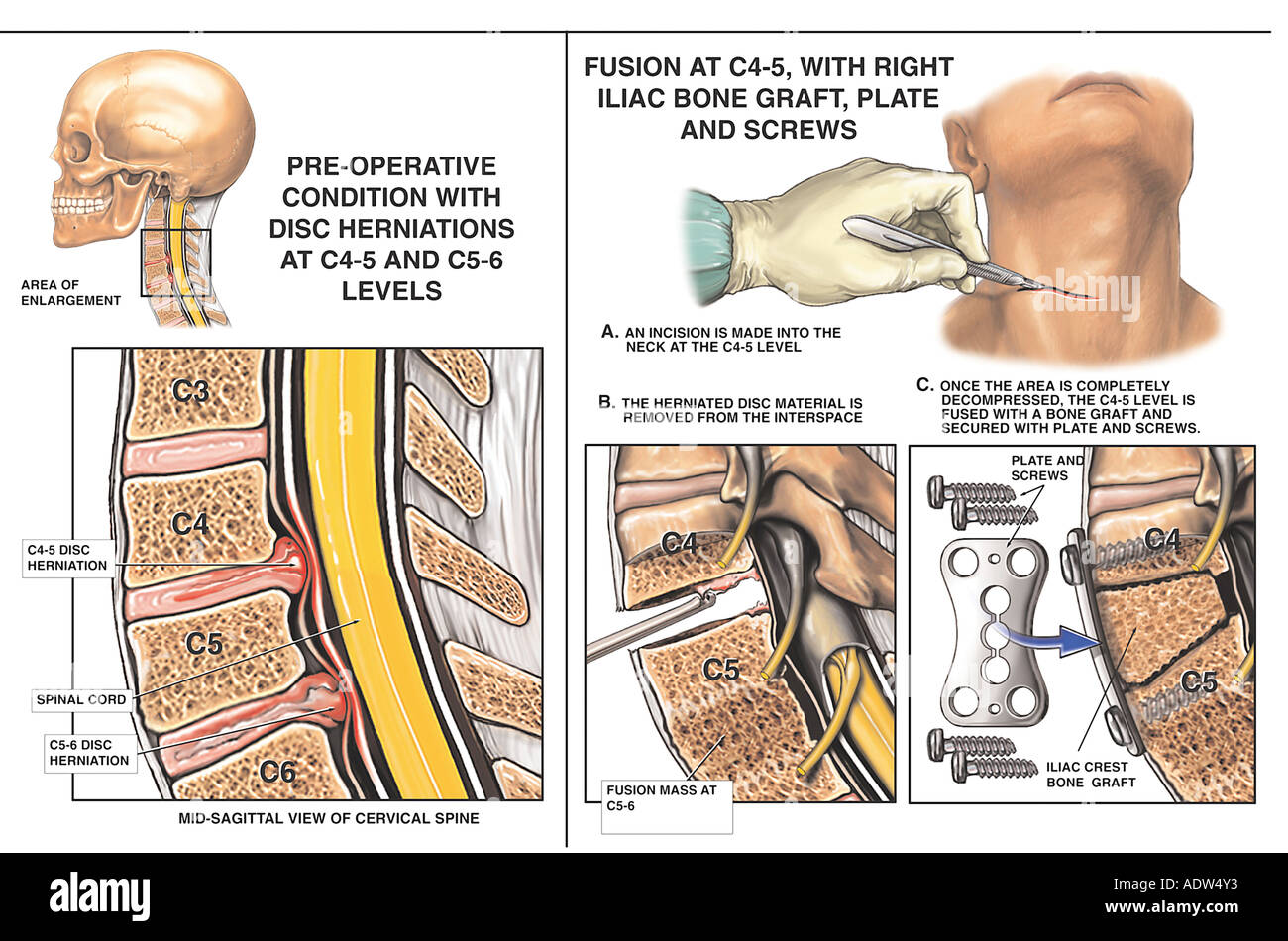 C4 c5 c6 columna vertebral fotografías e imágenes de alta resolución