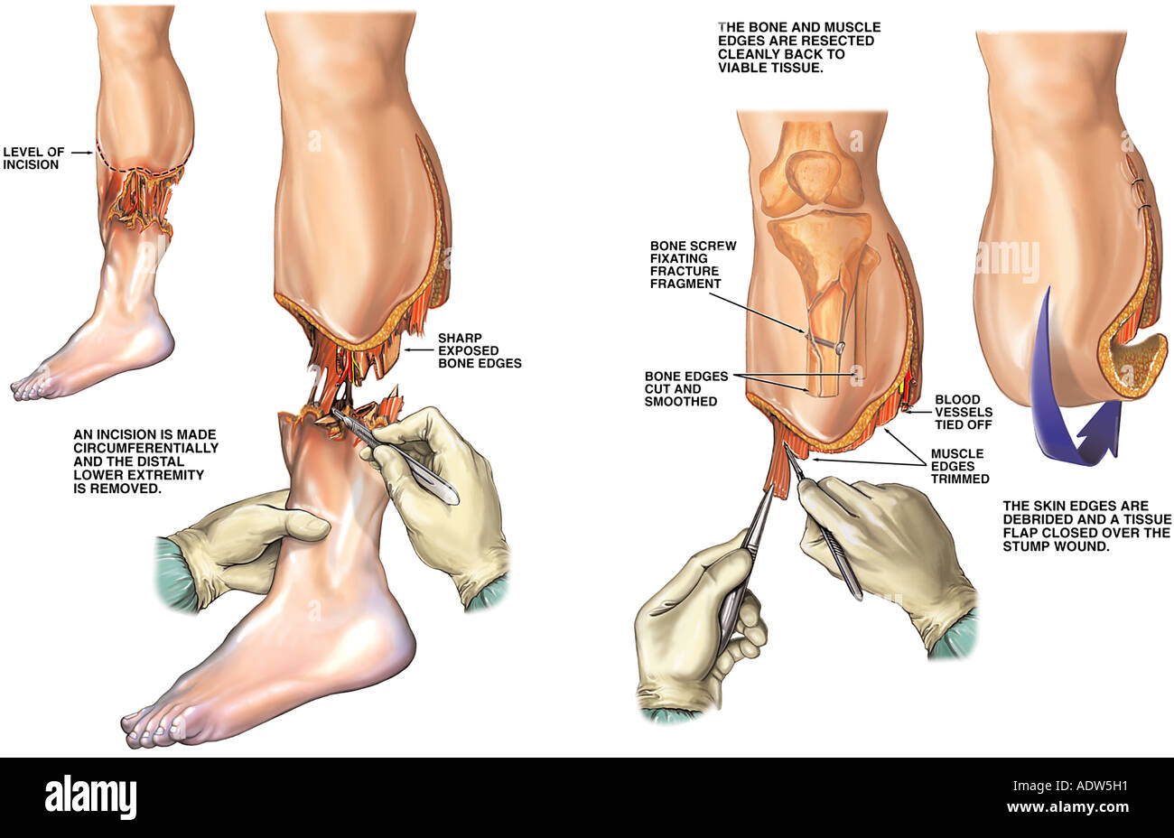 La amputación por debajo de la rodilla (pierna amputada). Foto de stock