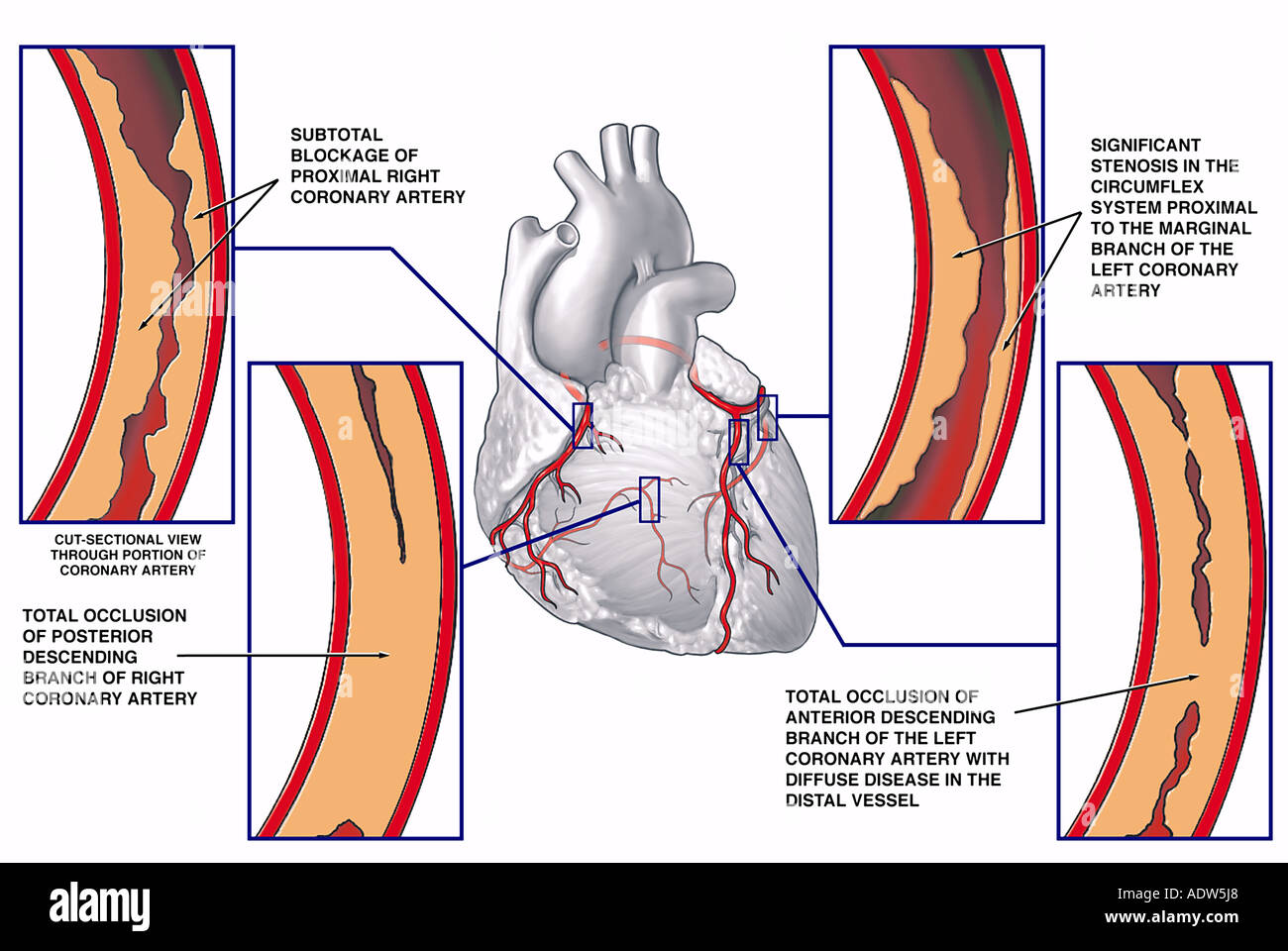 Arteria descendente anterior proximal fotografías e imágenes de alta