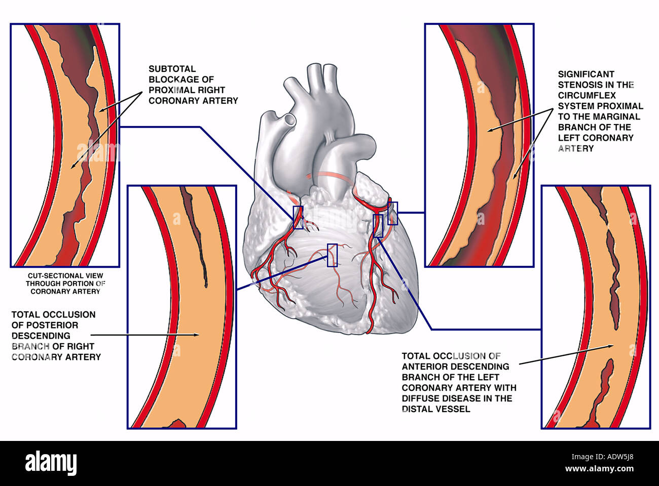 Enfermedad De La Arteria Coronaria Con Obstrucción Sitios Fotografía De