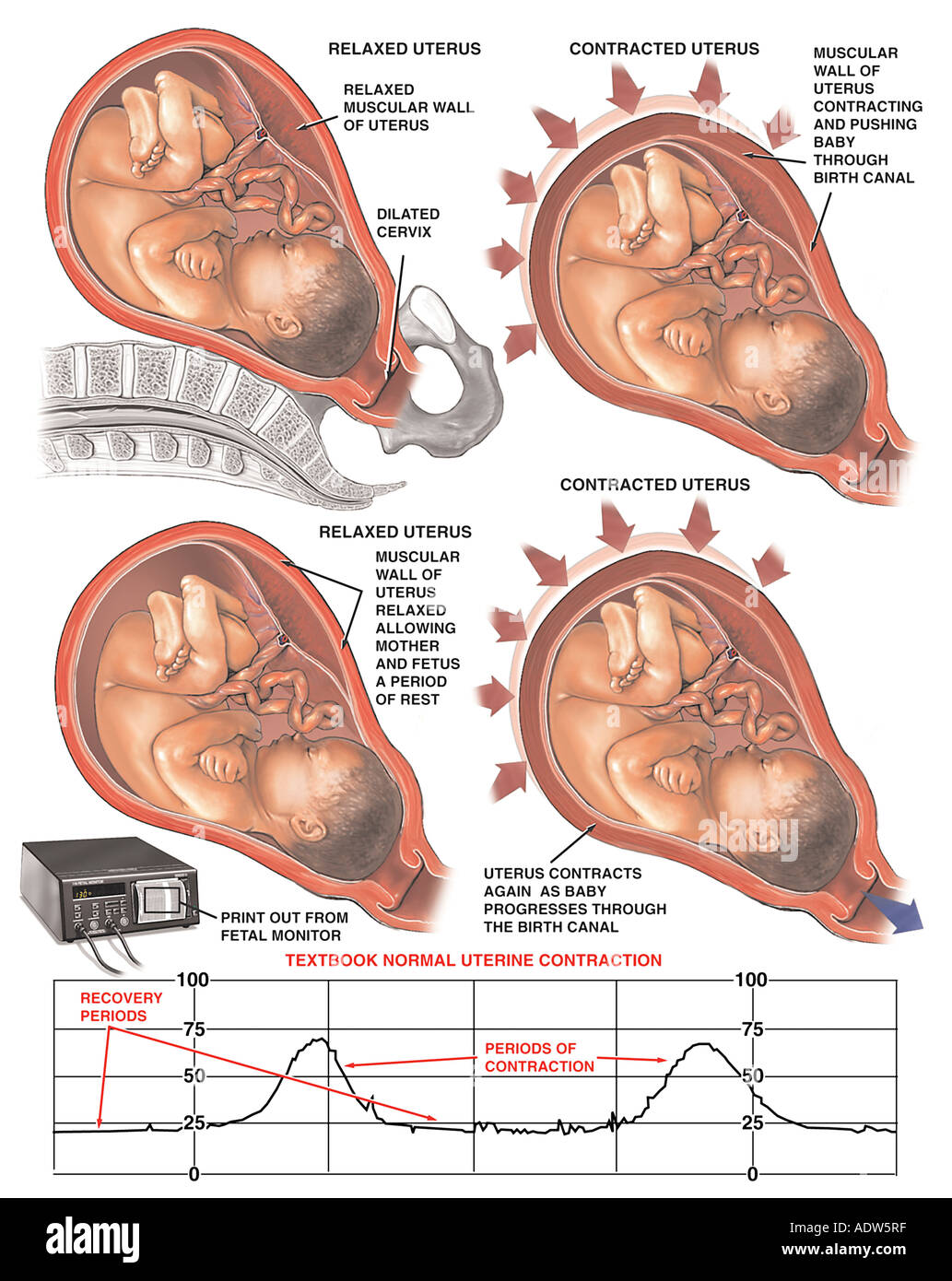 El trabajo de parto y el parto, las contracciones uterinas normales con  tira de monitorización fetal Fotografía de stock - Alamy