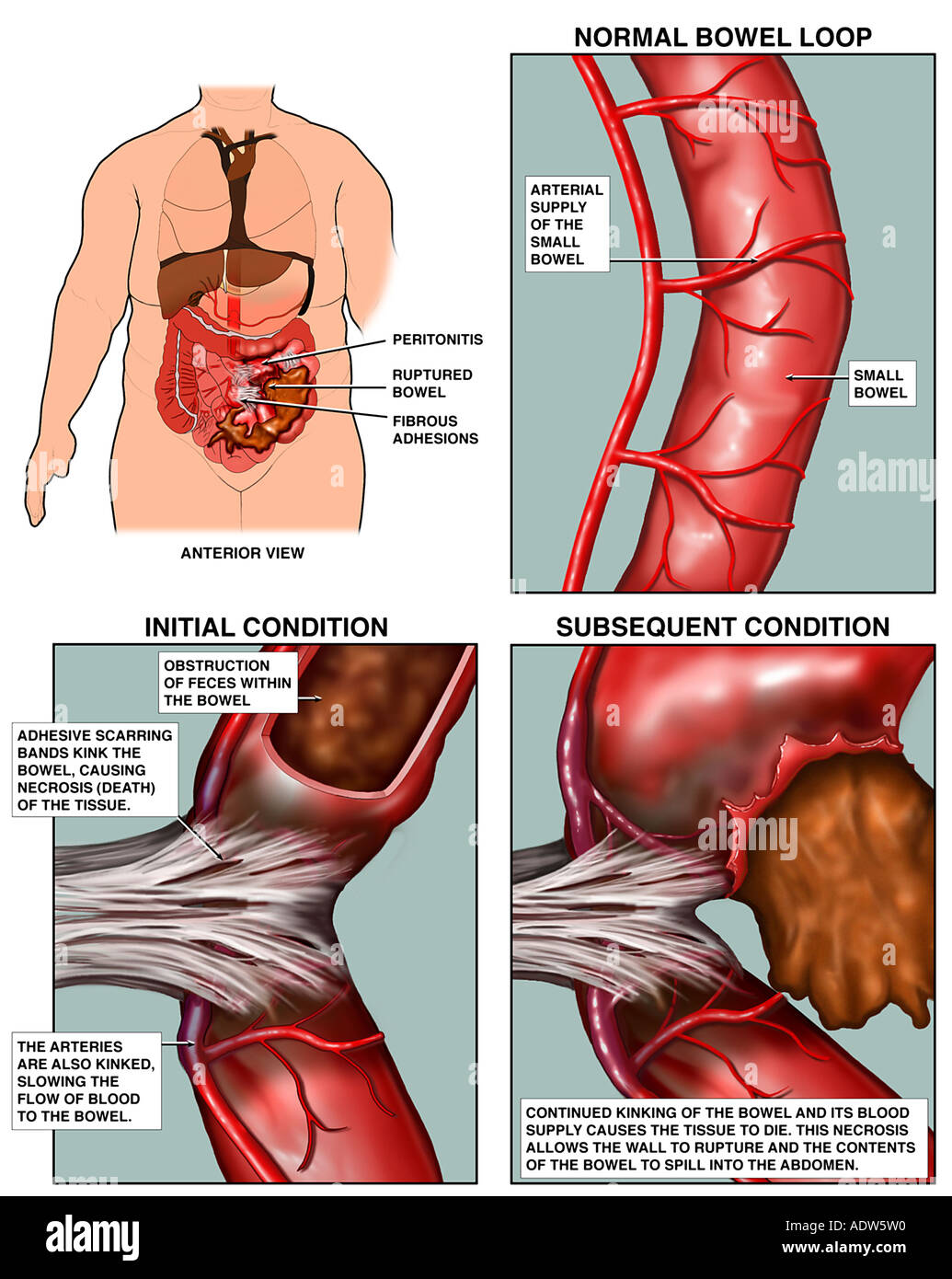 Perforación intestinal fotografías e imágenes de alta resolución - Alamy