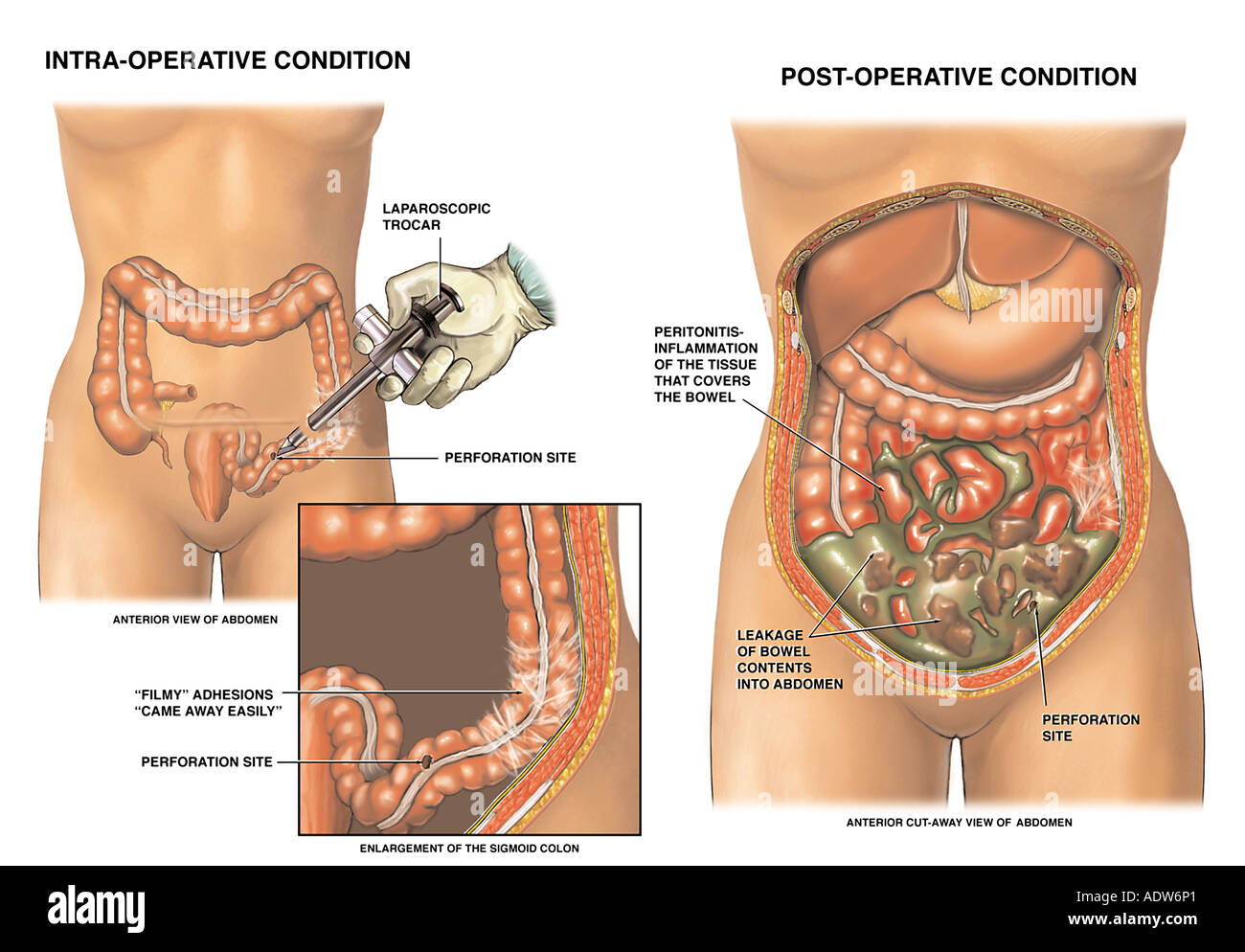 Cirugía laparoscópica con intestino (intestino grueso) Perforación  Fotografía de stock - Alamy