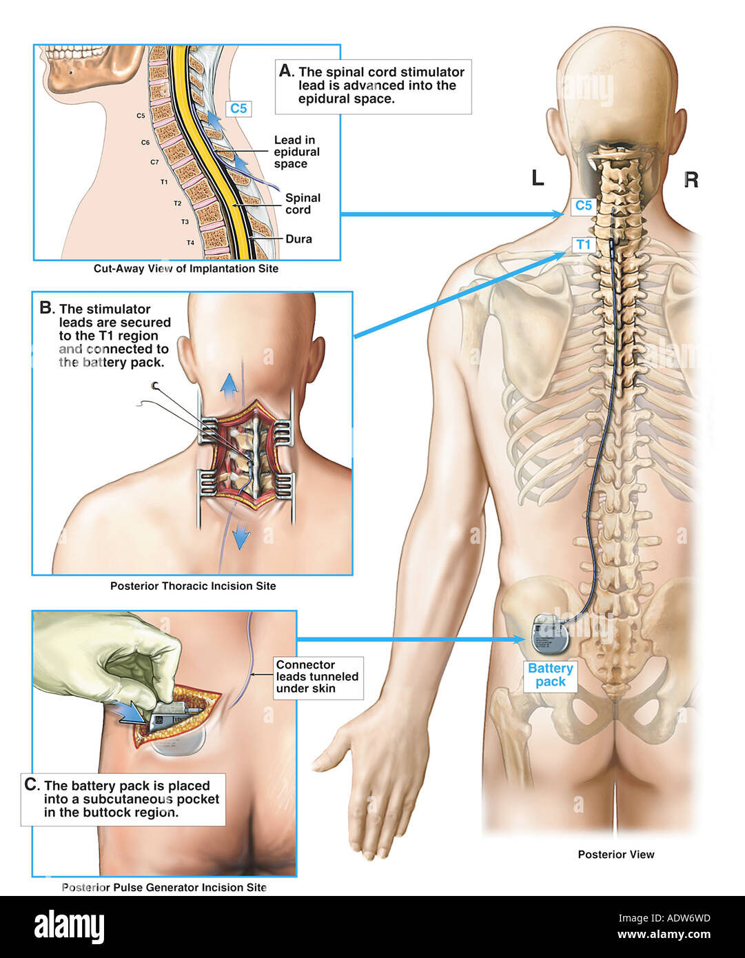 Implantación de estimulador de la médula espinal y el generador de pulso Foto de stock