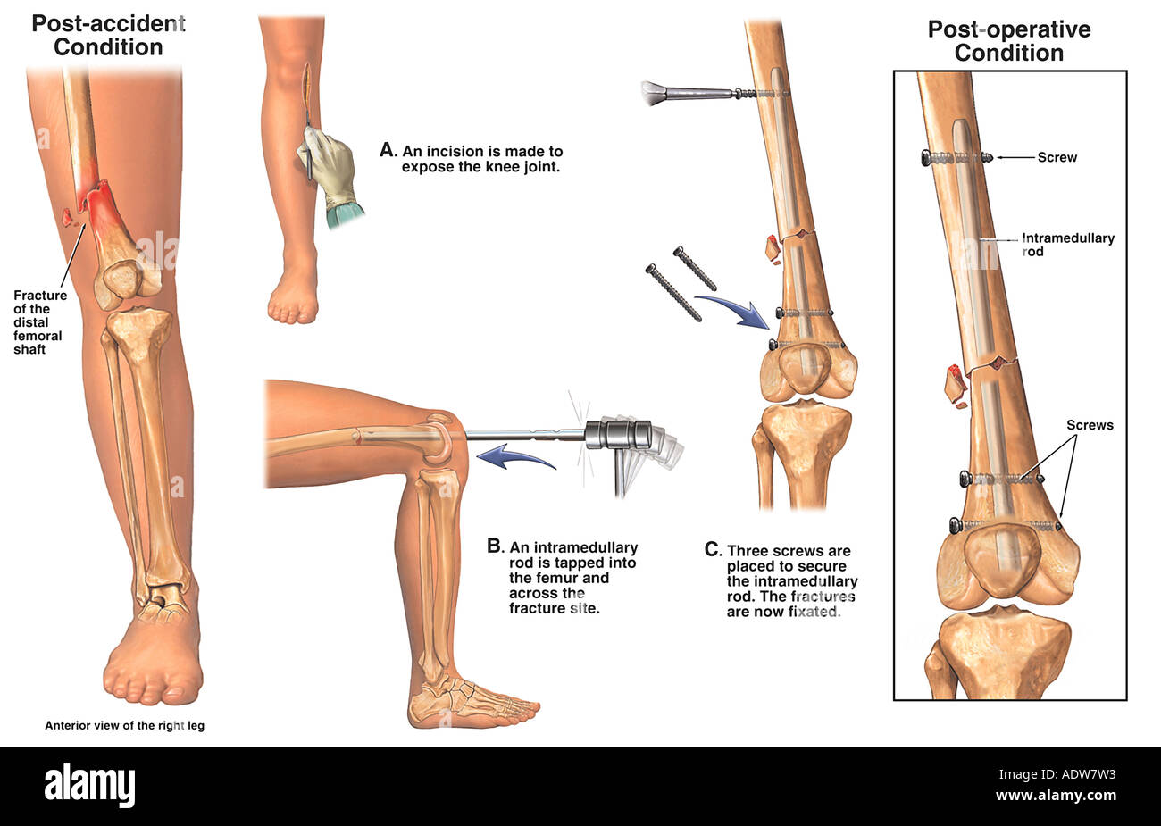 Fracturas de f mur distal con fijaci n quir rgica retr grada con clavo 