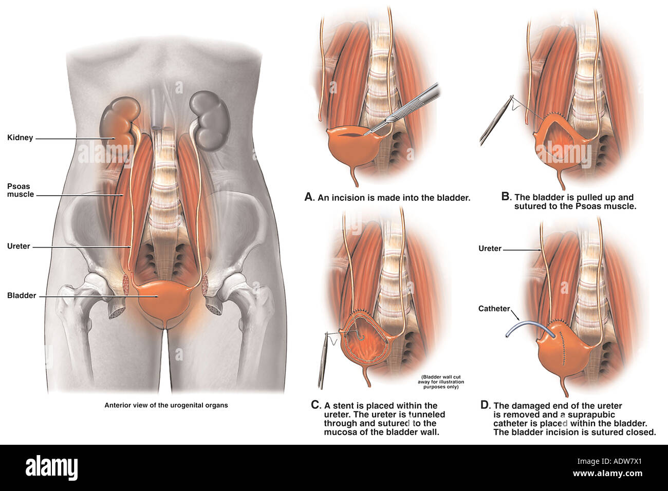 Ureter bladder surgery fotografías e imágenes de alta resolución - Alamy