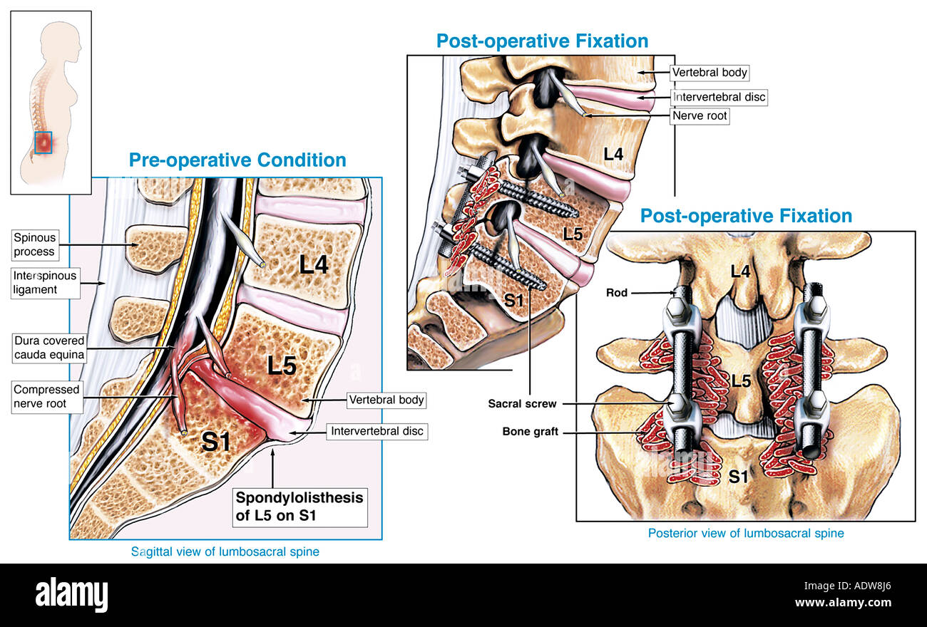 Cirugía de fusión vertebral L5 S1 espondilolistesis con la reparación  quirúrgica de la columna vertebral Fotografía de stock - Alamy