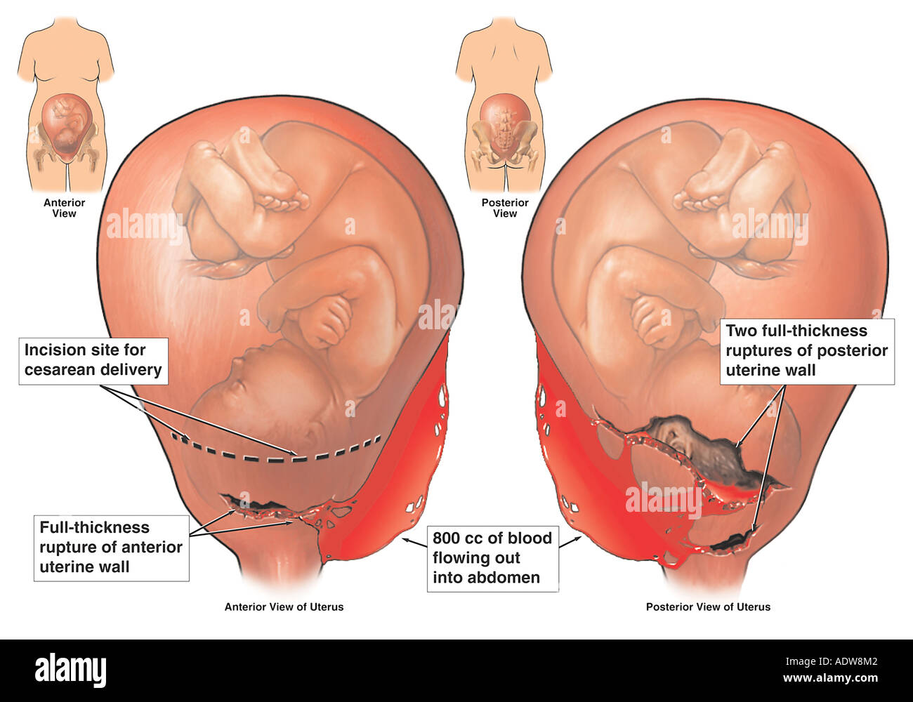 Ruptura uterina fotografías e imágenes de alta resolución - Alamy