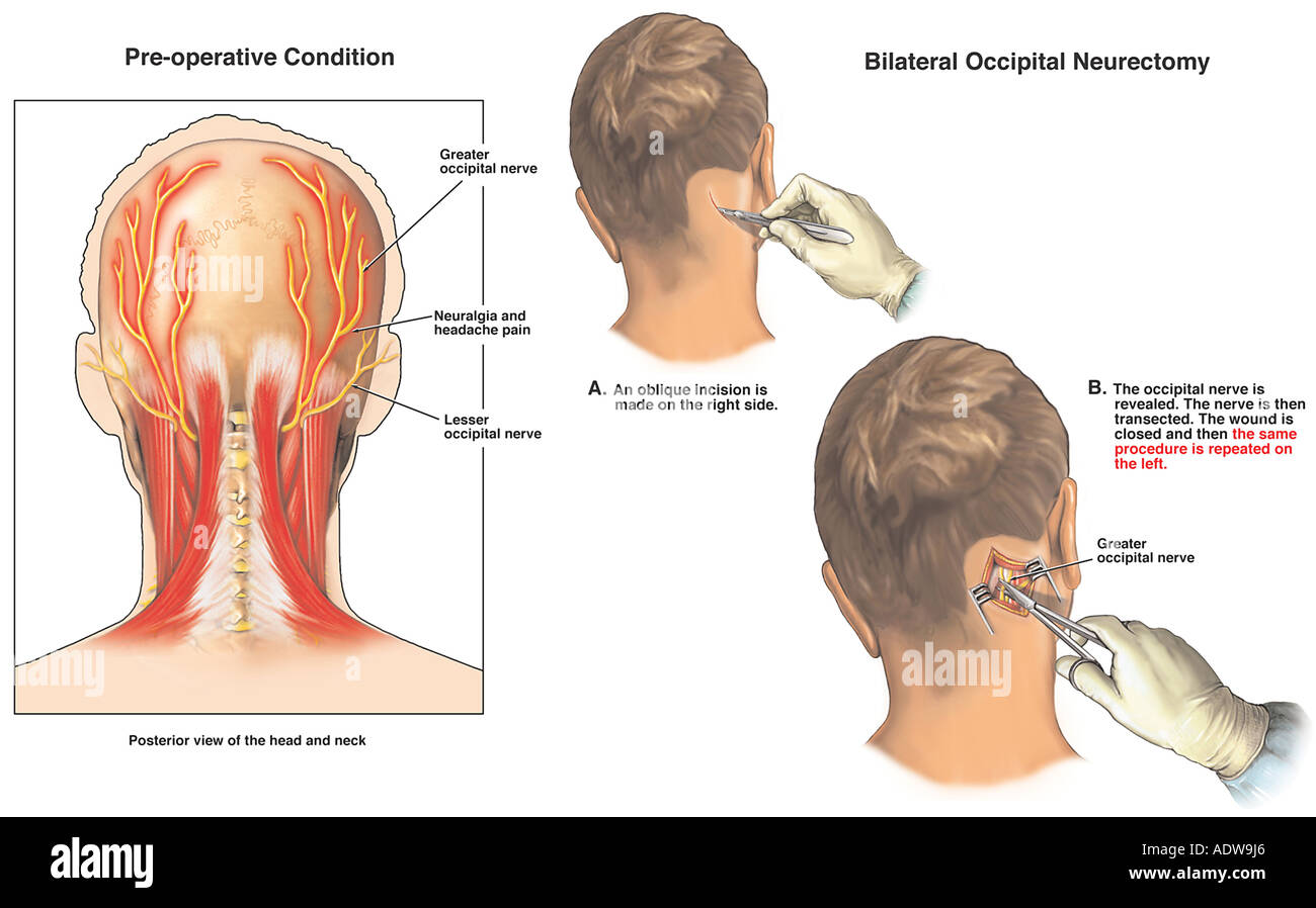 El Dolor De Cabeza Neuralgia Occipital Con Nervio Neurectom a 