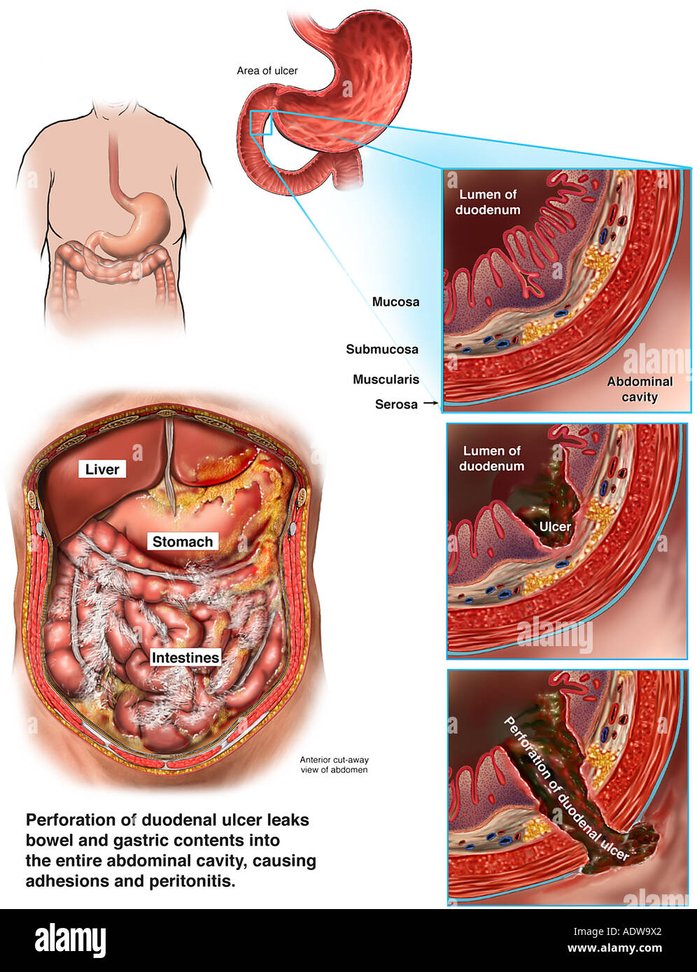 Perforación de úlcera duodenal con Peritonitis Generalizada Fotografía de  stock - Alamy