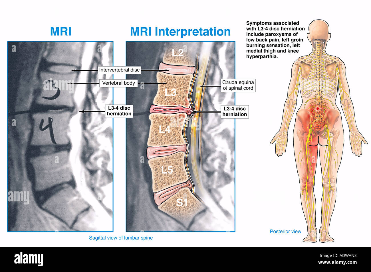 Hernia de disco lumbar con lesiones a la médula espinal (cauda equina