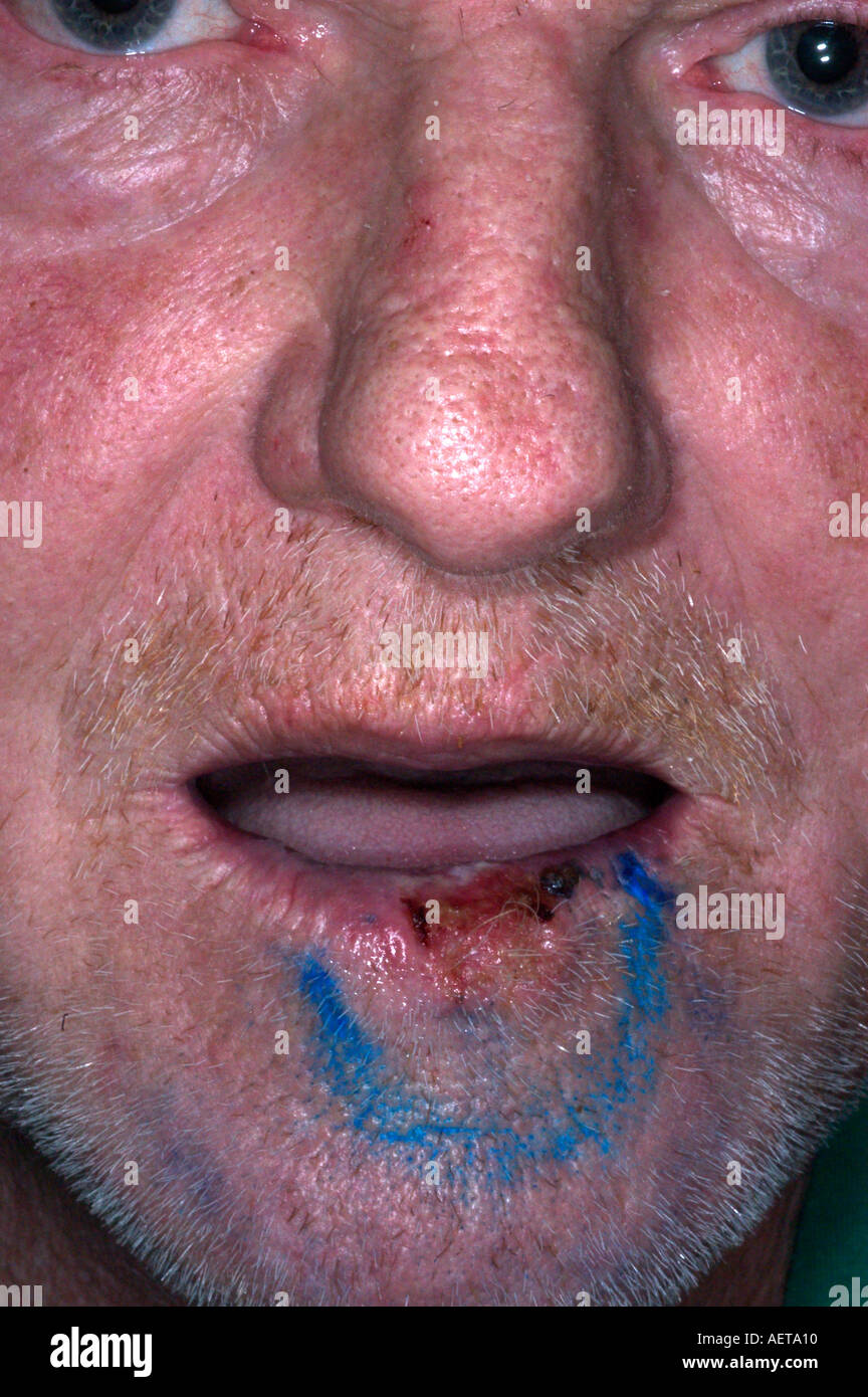 Carcinoma epidermoide de labio Los distintivos azules se usan para guiar donde para administrar