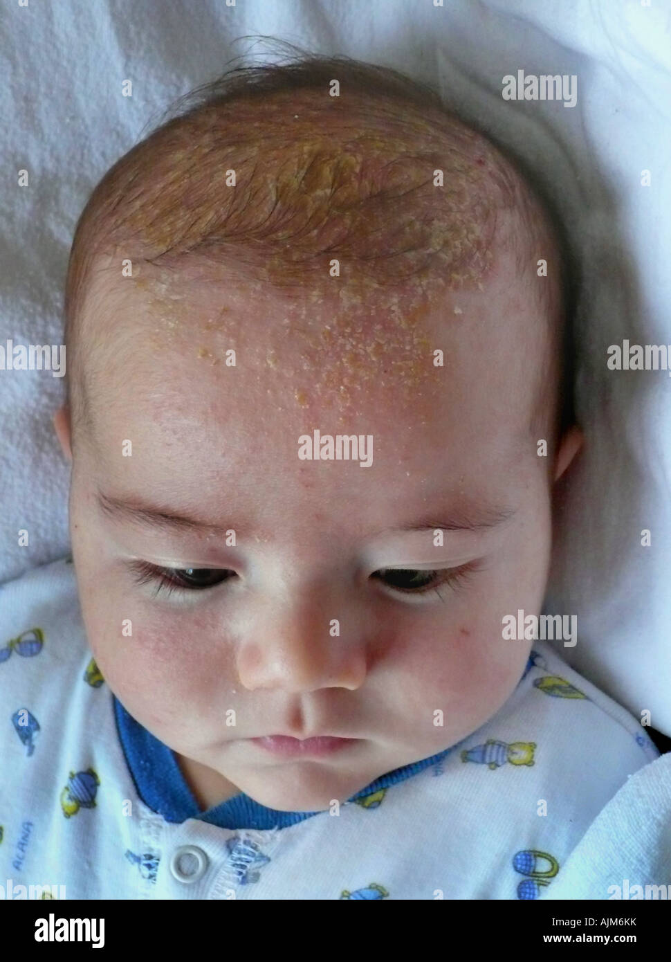 Bebé con costra láctea Fotografía de stock - Alamy