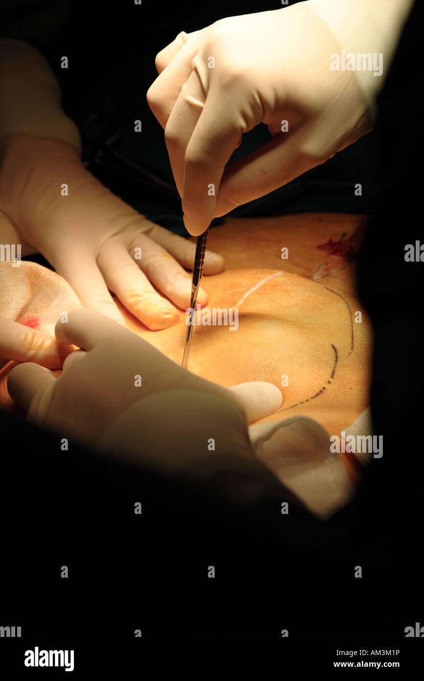 Incisión inicial en pacientes con piel de bisturí Foto de stock