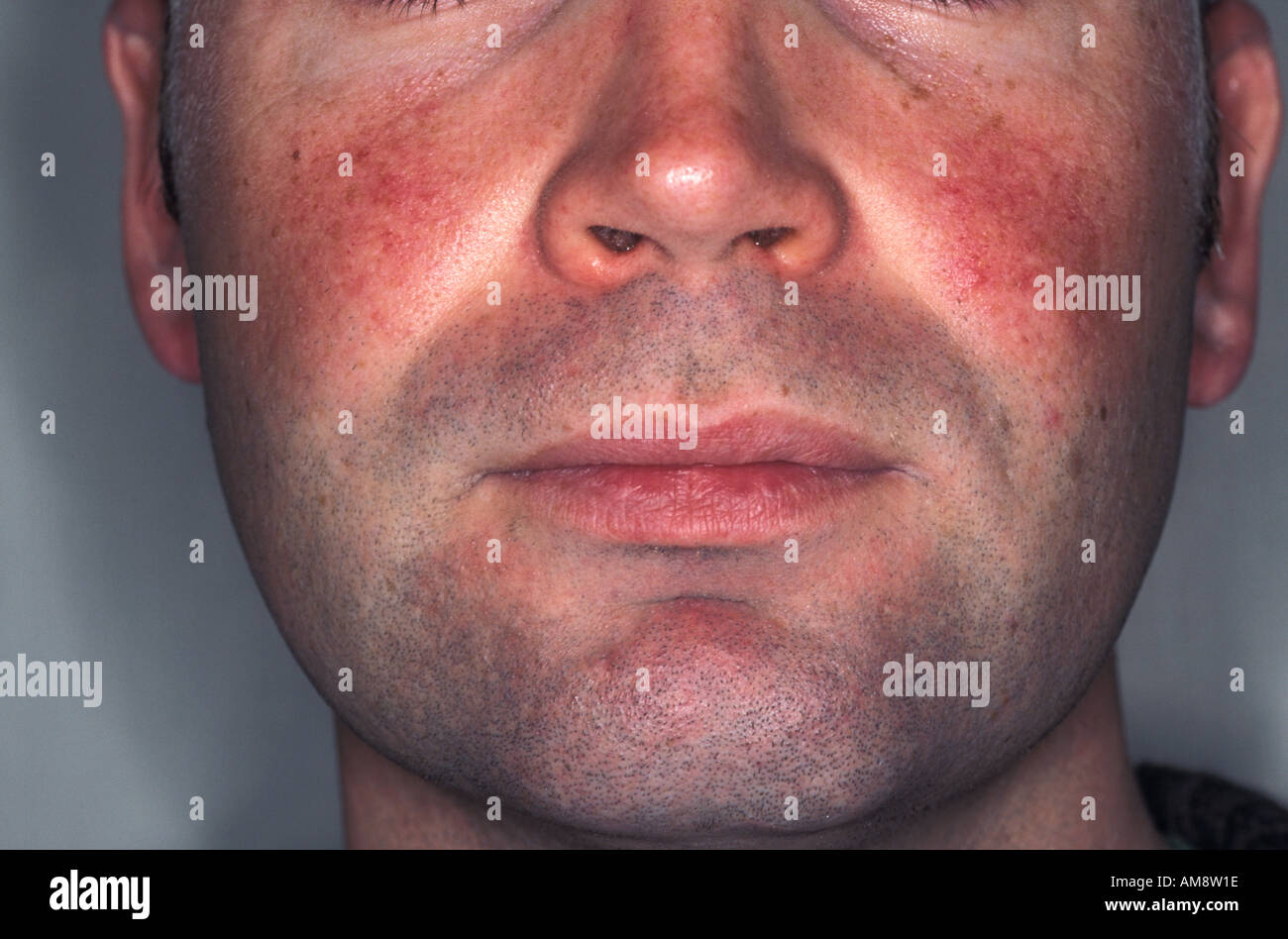 Rosacea mejillas fotografías e imágenes de alta resolución - Alamy