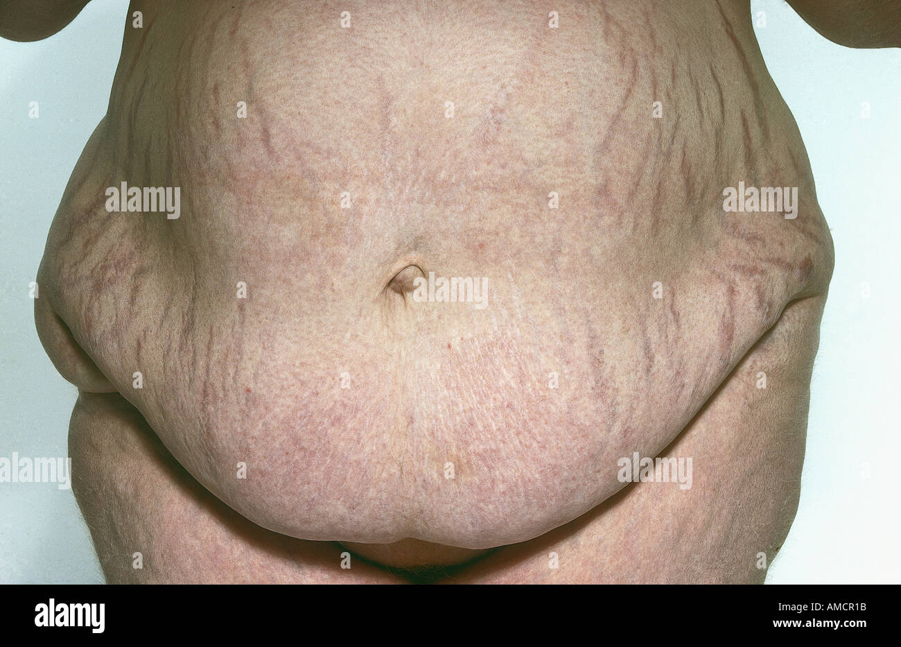 Síndrome de Cushing estrías Fotografía de stock Alamy