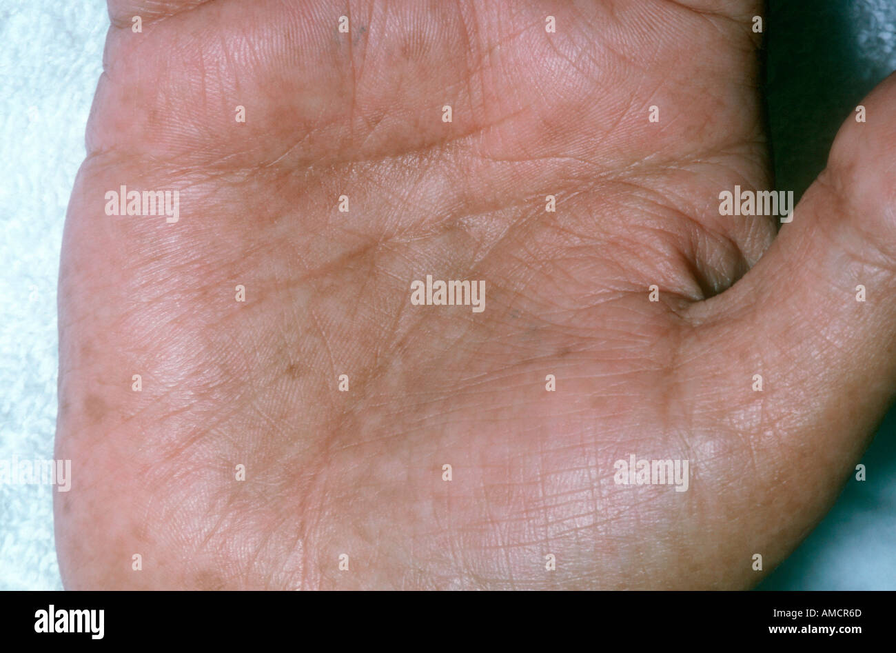 Enfermedad de Addison Foto & Imagen De Stock 4970348 Alamy