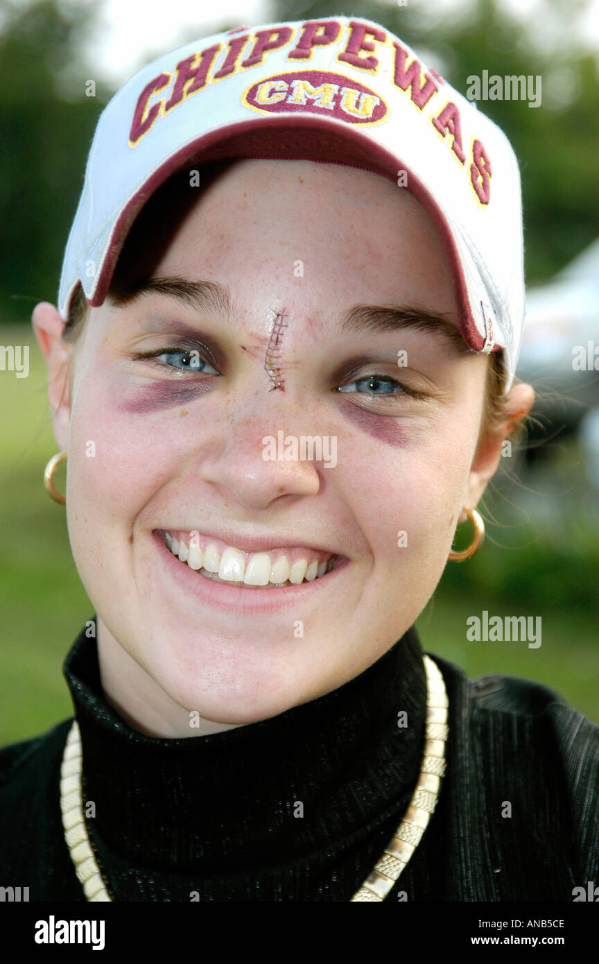 Herido Teen hembra con ojos negros y suturas como resultado de ser pateado por un caballo Foto de stock