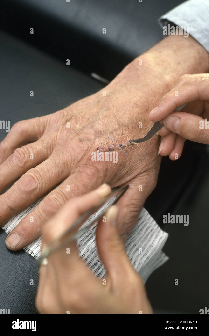 Extracción de puntos de sutura en una mano Foto de stock