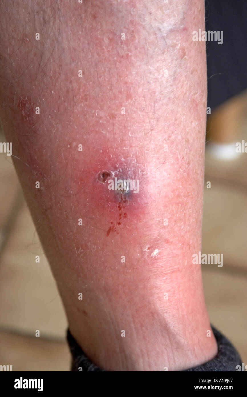 Pierna herida séptica y la costra en la espinilla de un varón de mediana  edad Fotografía de stock - Alamy