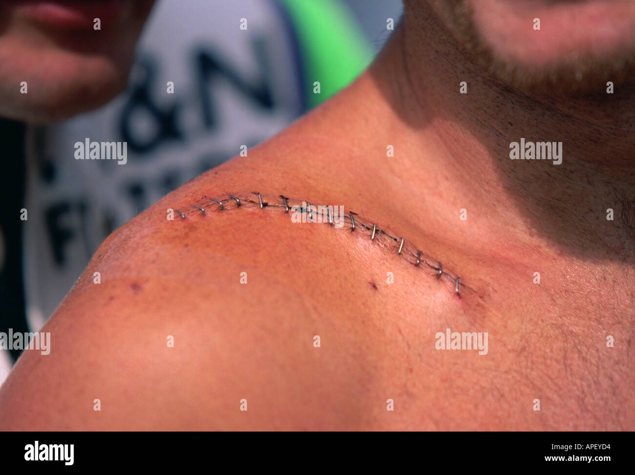 Speedway cicatriz con puntos de sutura, cerrar Foto de stock