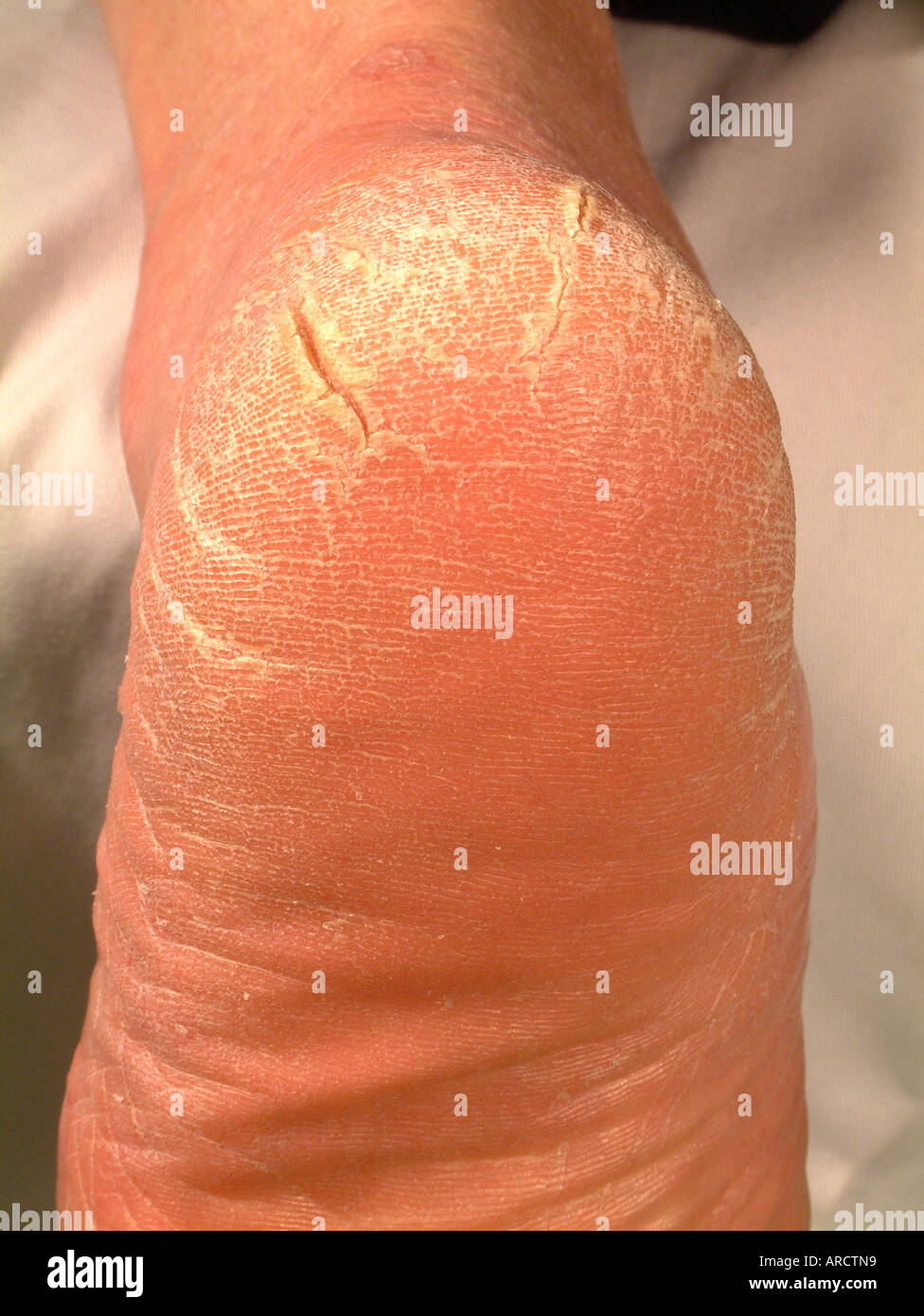 Esta es una fotografía que muestra la piel agrietada en el talón, el efecto  doloroso de la piel seca Fotografía de stock - Alamy