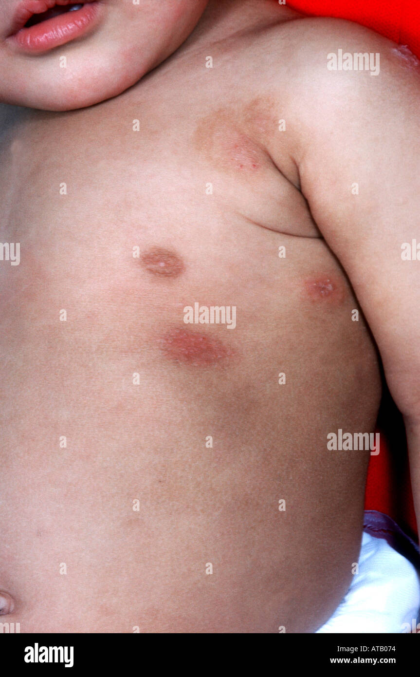 La anemia por deficiencia de hierro Fotografía de stock - Alamy