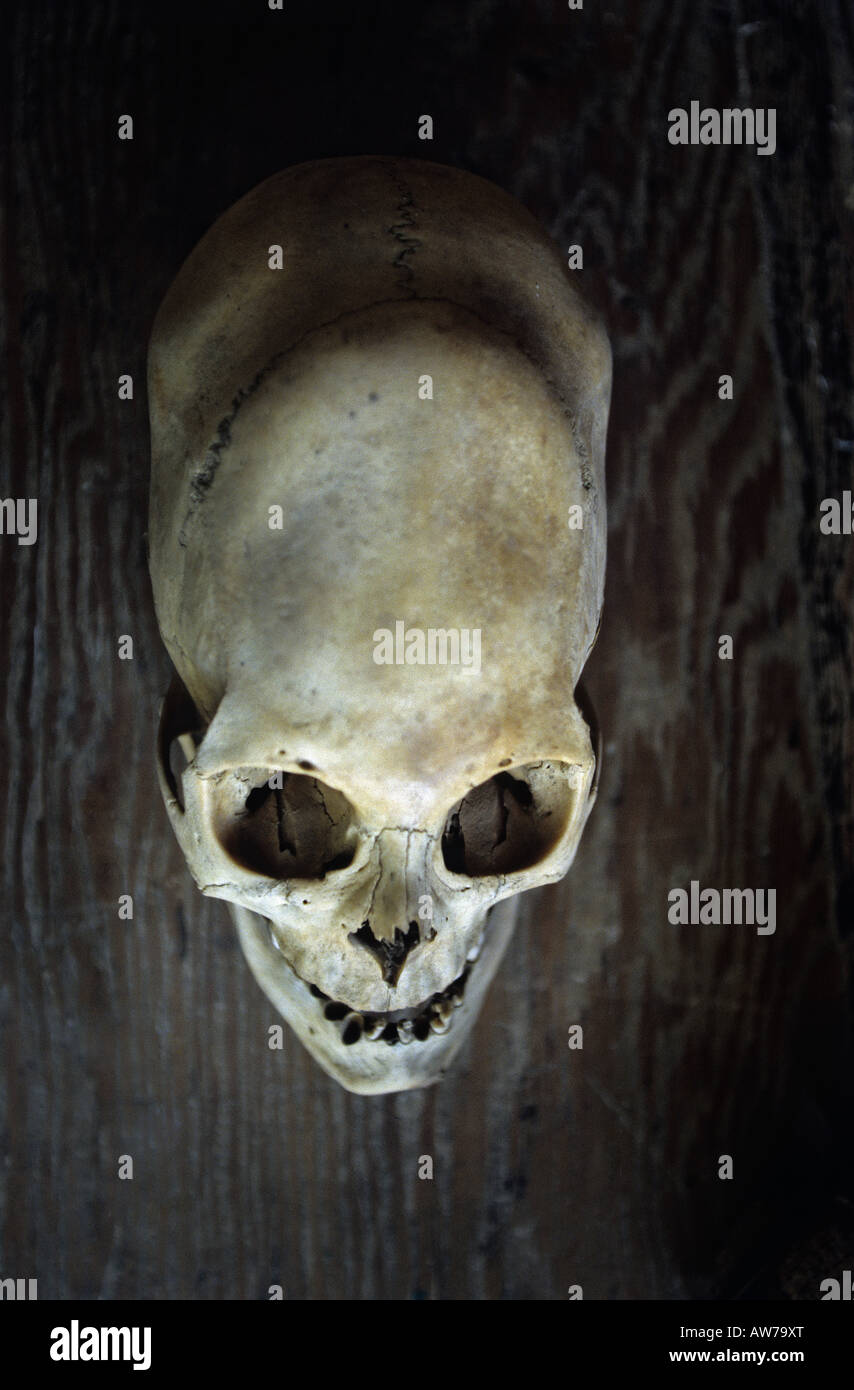 Una deformación del cráneo de un nazcan (Perou Ica - Nazca). Cráneo déformé d'un nazcan (Ica - Nazca Pérou). Foto de stock