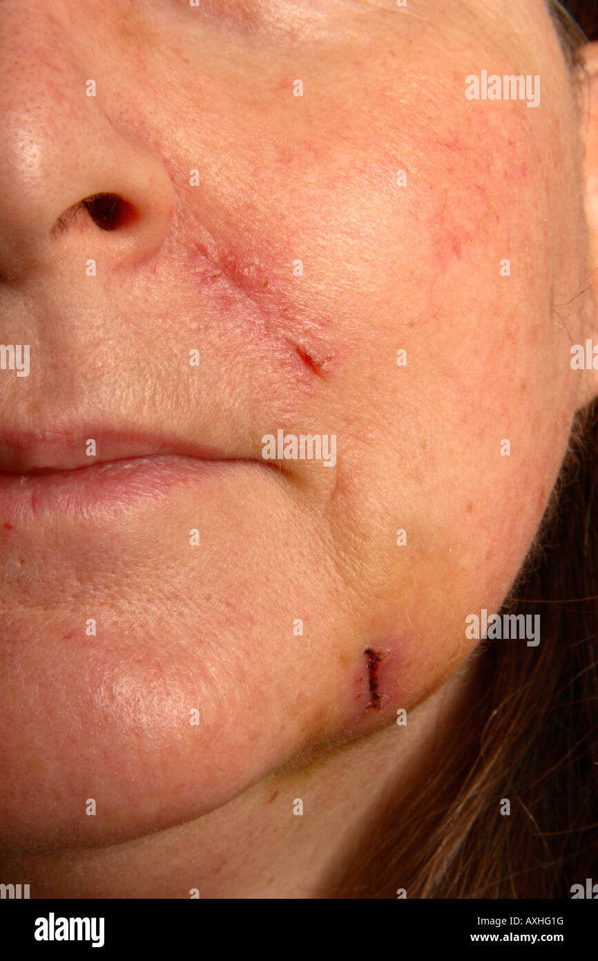 Cicatrices Después de Cirugía Estética