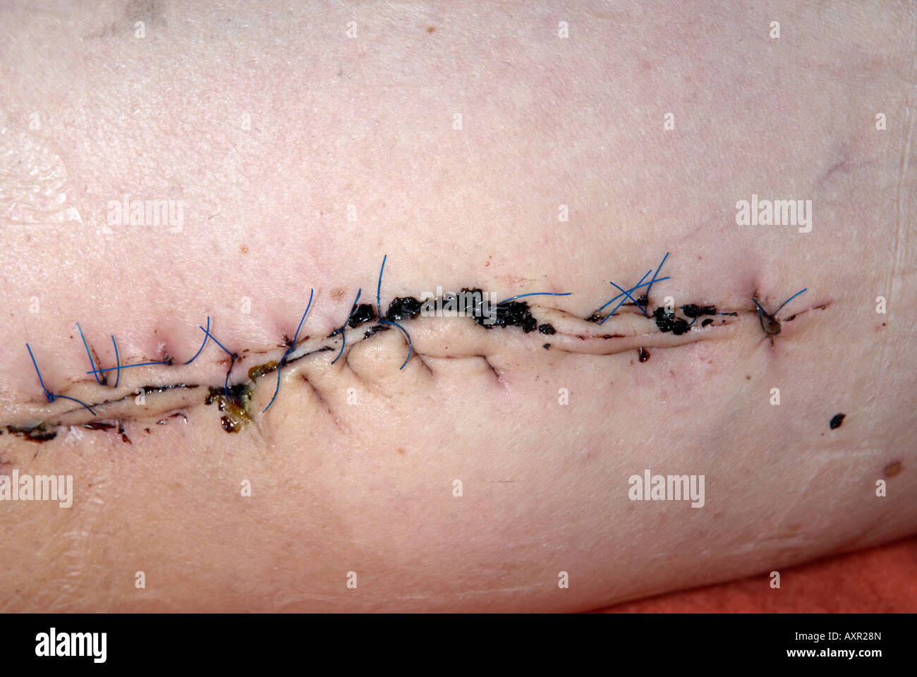 Cerca de puntos de sutura en la parte interior del muslo izquierdo, desde la operación para extraer un sarcoma de tejido blando de grado alto en las mujeres Foto de stock