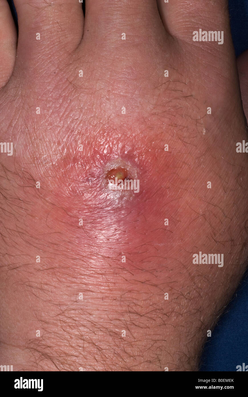 Absceso y celulitis de MRSA Staphylococcus aureus