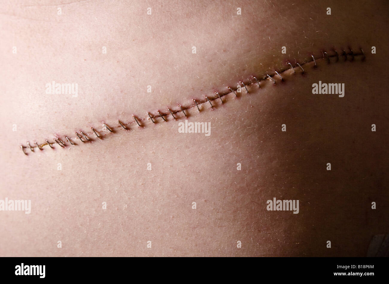 Puntos de sutura de la cirugía Foto de stock