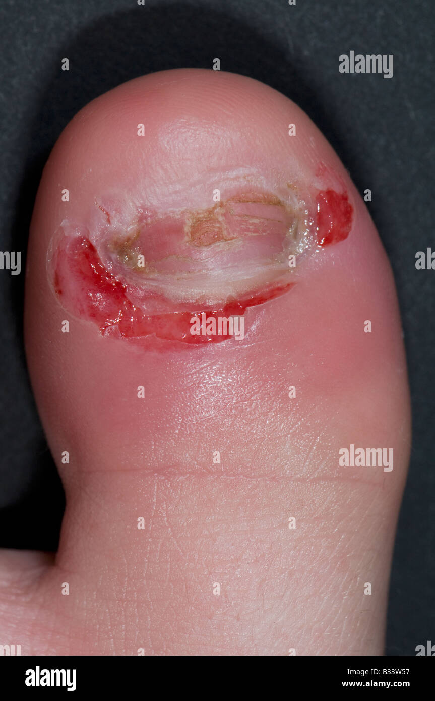 La paroniquia en el dedo gordo del pie de un niño de 9 años de edad después de la incisión y drenaje Foto de stock
