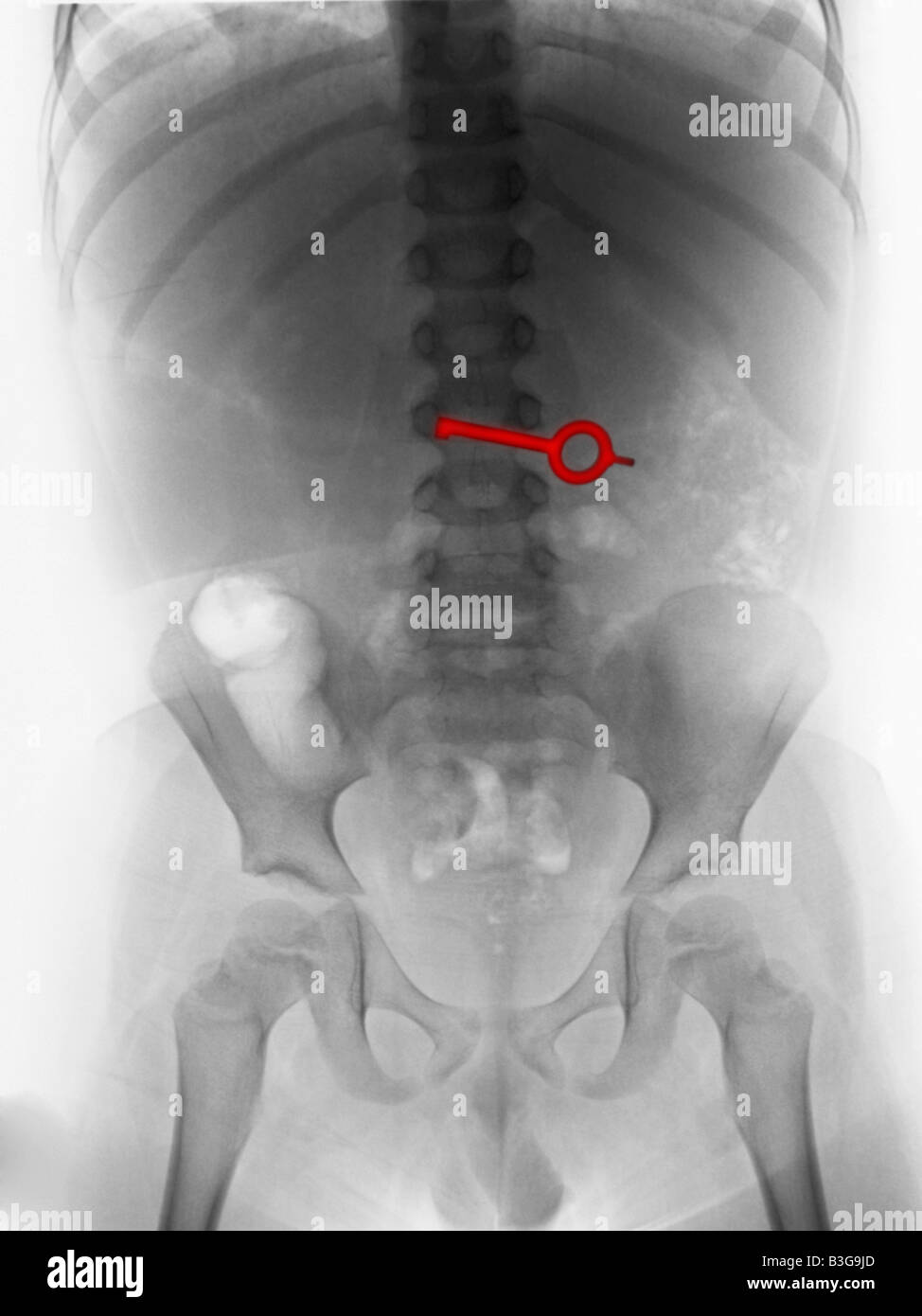 Radiografía del abdomen de un joven que ingirió una clave Foto de stock