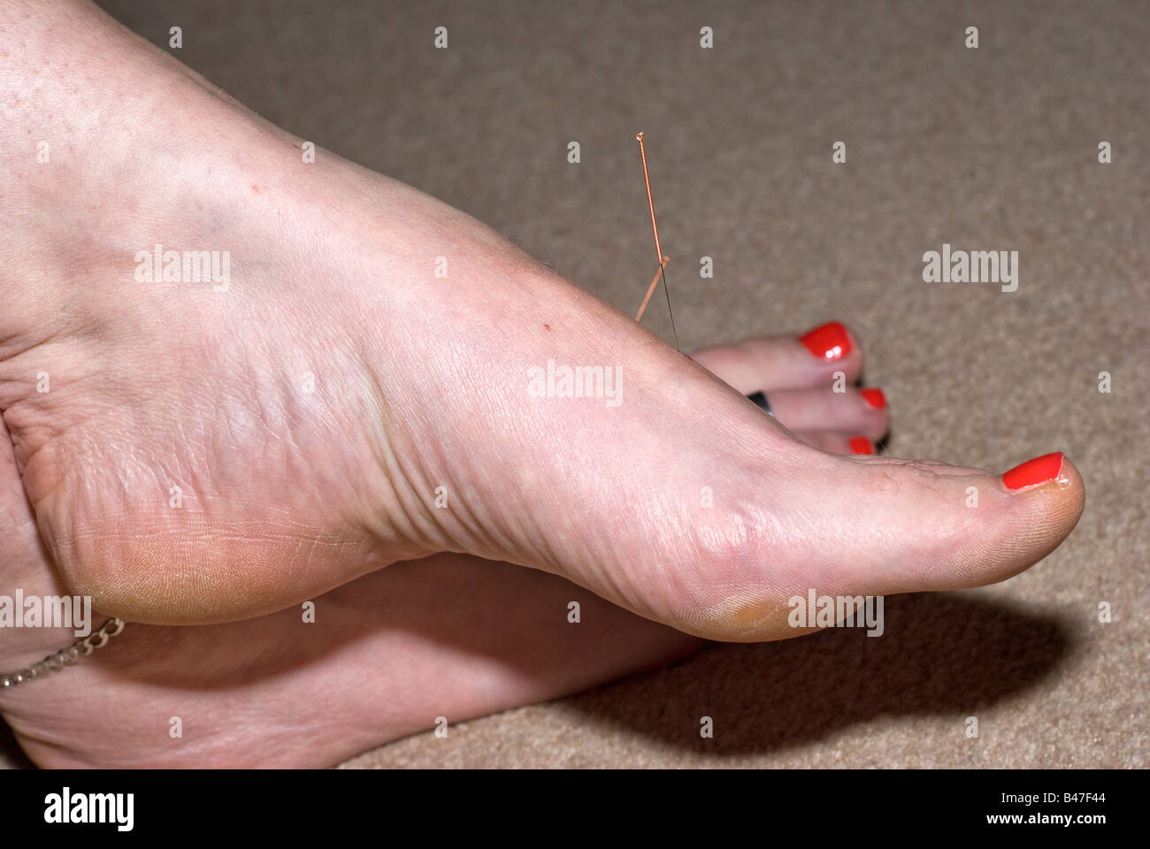Aguja de acupuntura en el hígado 3 punto de pie Foto de stock
