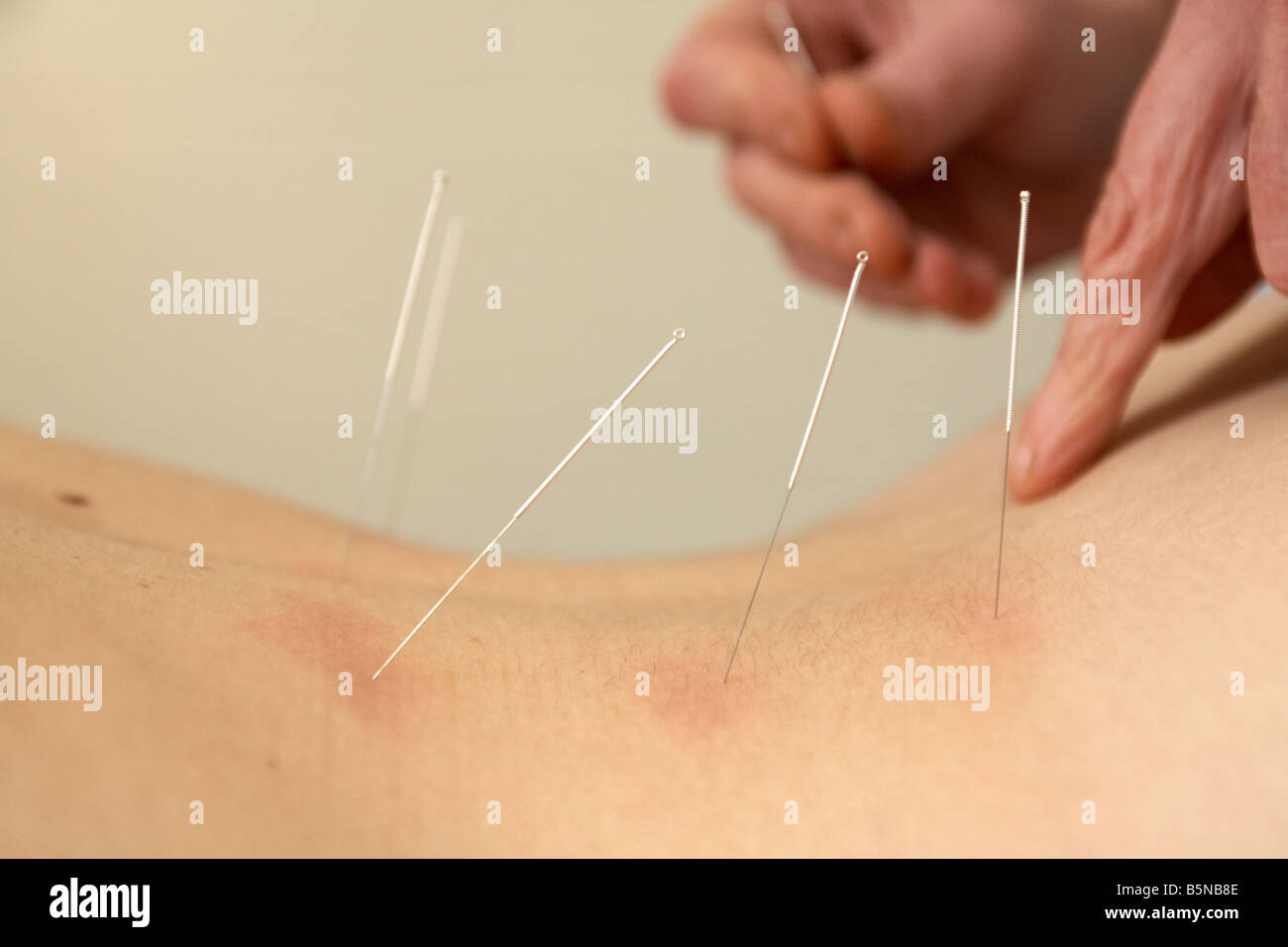 Acupunturista femenina aplicando las agujas de acupuntura en la parte inferior de la espalda de una mujer adulta fines del veinte para aliviar el dolor de espalda Foto de stock