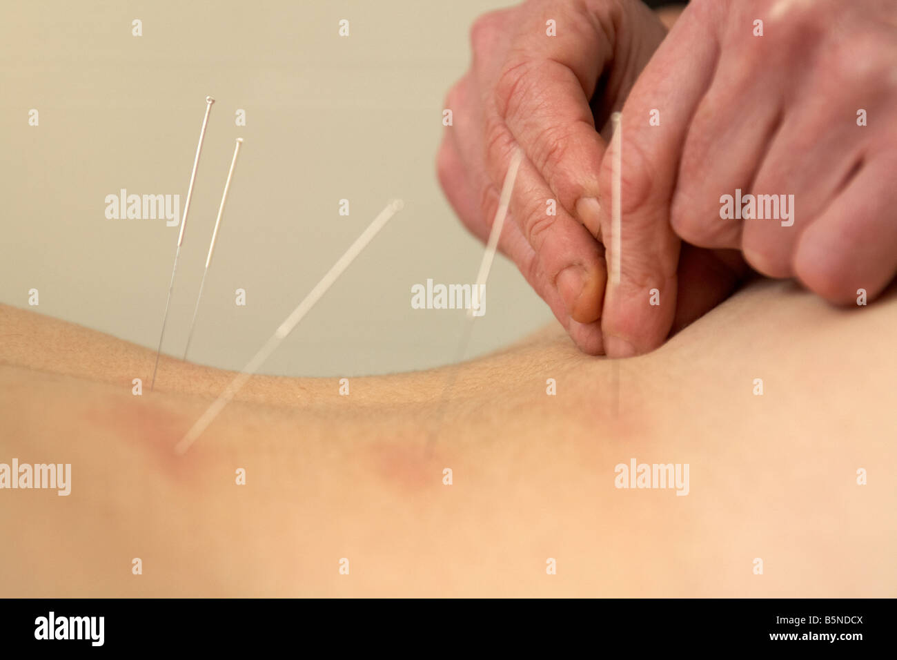 Acupunturista femenina aplicando las agujas de acupuntura en la parte inferior de la espalda de una mujer adulta fines del veinte para aliviar el dolor de espalda Foto de stock