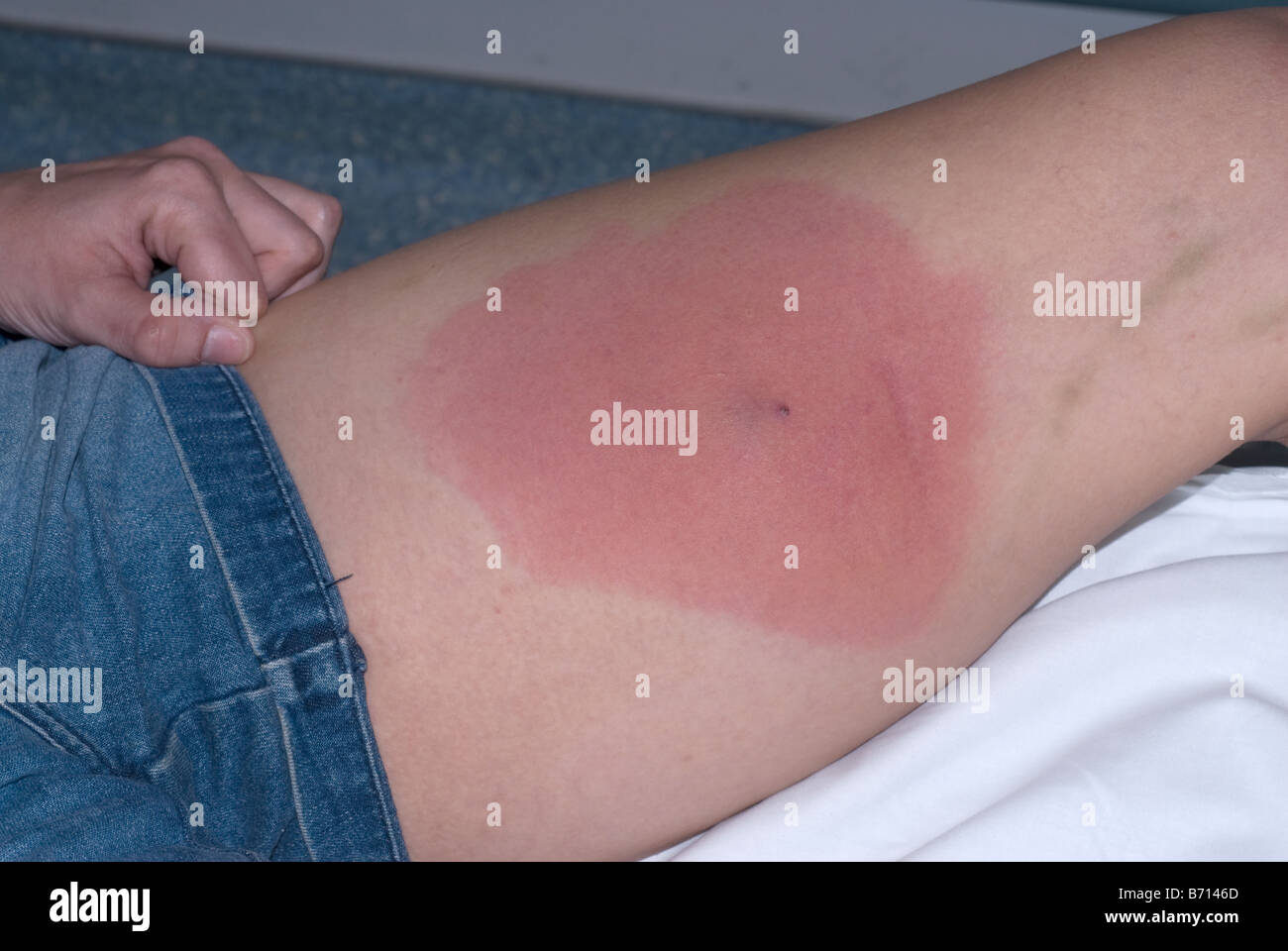 Staphylococcus aureus resistente a la meticilina MRSA infección de la piel del muslo Foto de stock