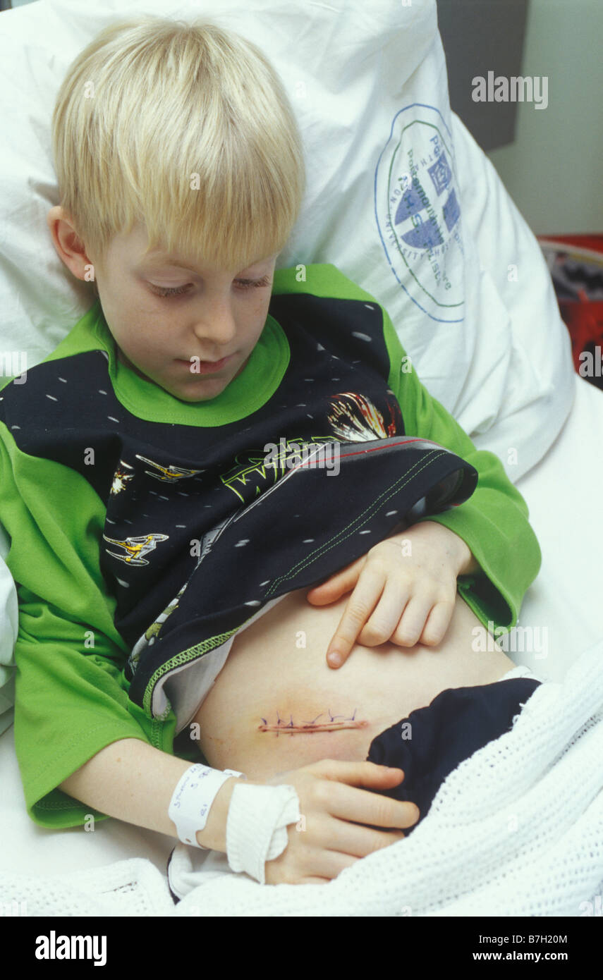 Niño acostado en la cama después de su apéndice ha sido eliminado mirando su cicatriz y suturas Foto de stock