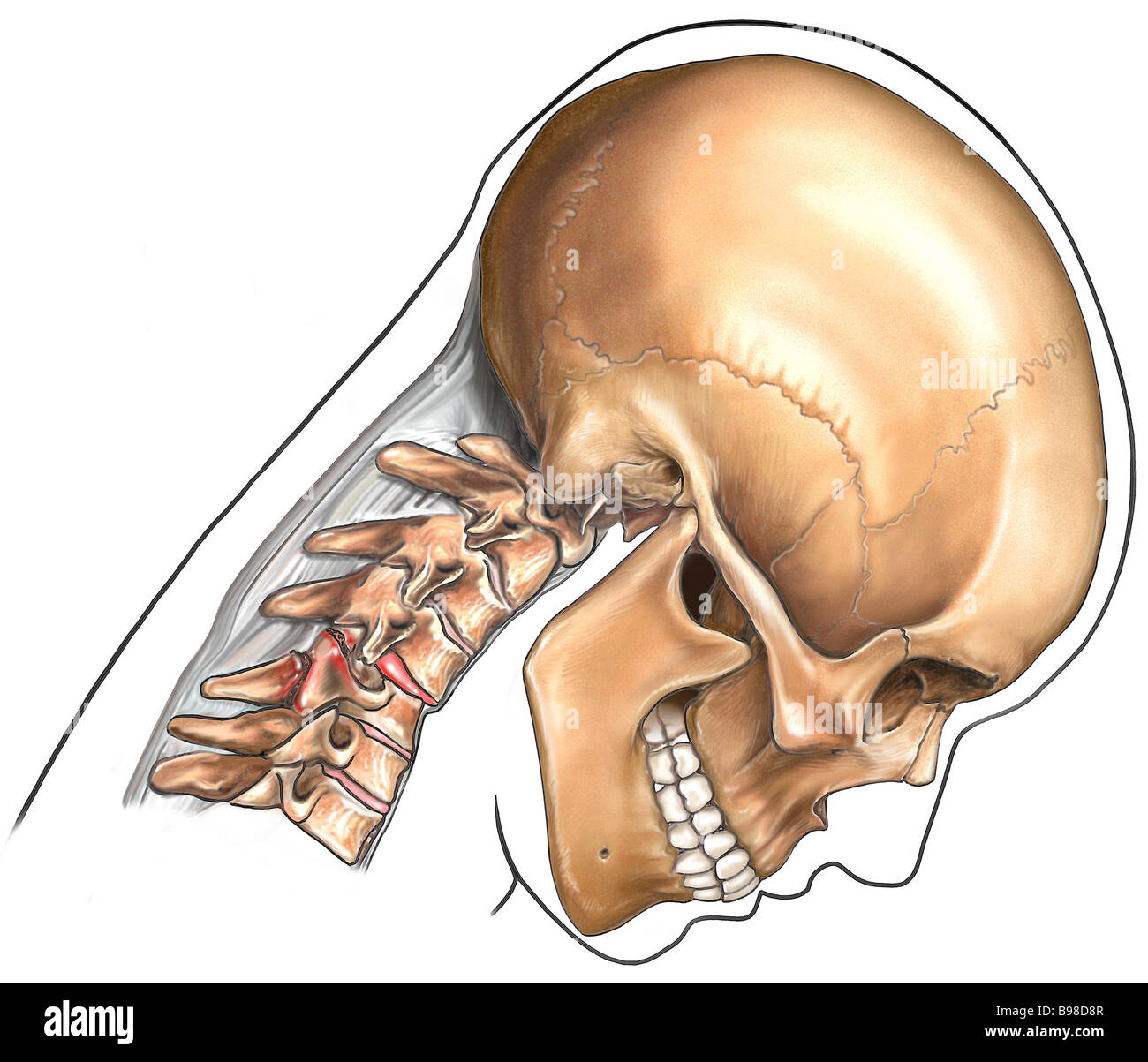 Fractura cervical fotografías e imágenes de alta resolución Alamy