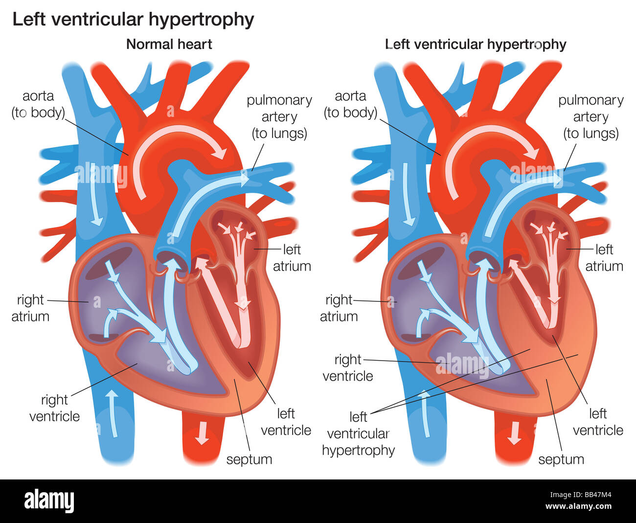 Comparando la sección transversal de la pared ventricular izquierda del corazón normal a una pared ventricular izquierda que ha experimentado la hipertrofia. Foto de stock
