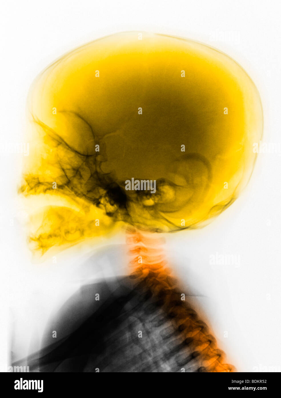 Radiografía de cráneo normal de un niño de 6 meses de antigüedad Foto de stock